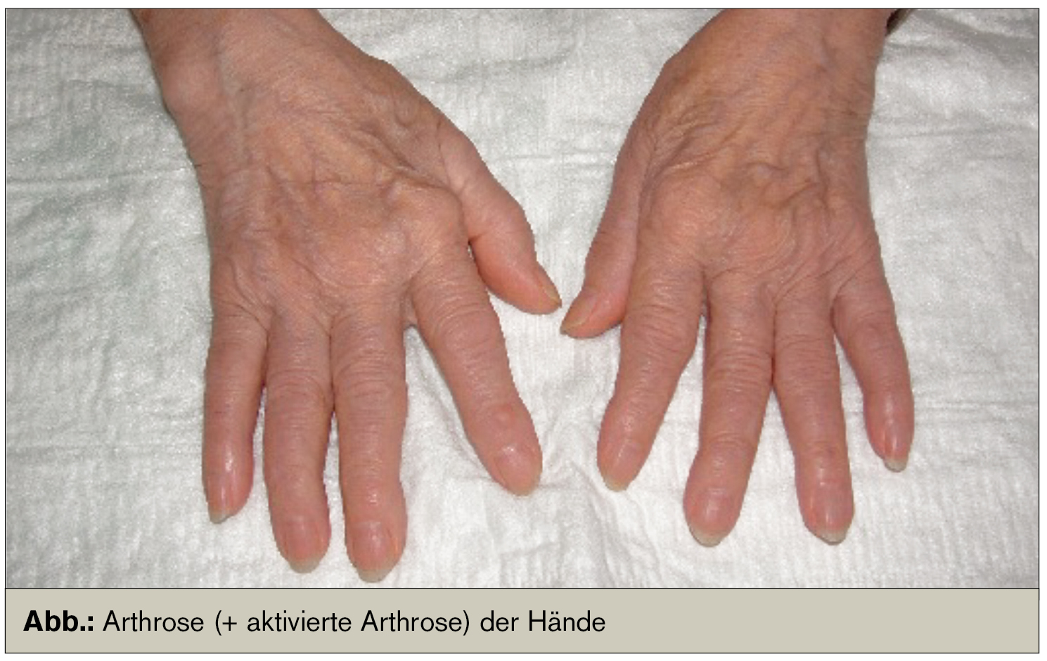 Arthrose und Arthritis – Die Rolle des Internisten | Universum Innere Medizin | MedMedia